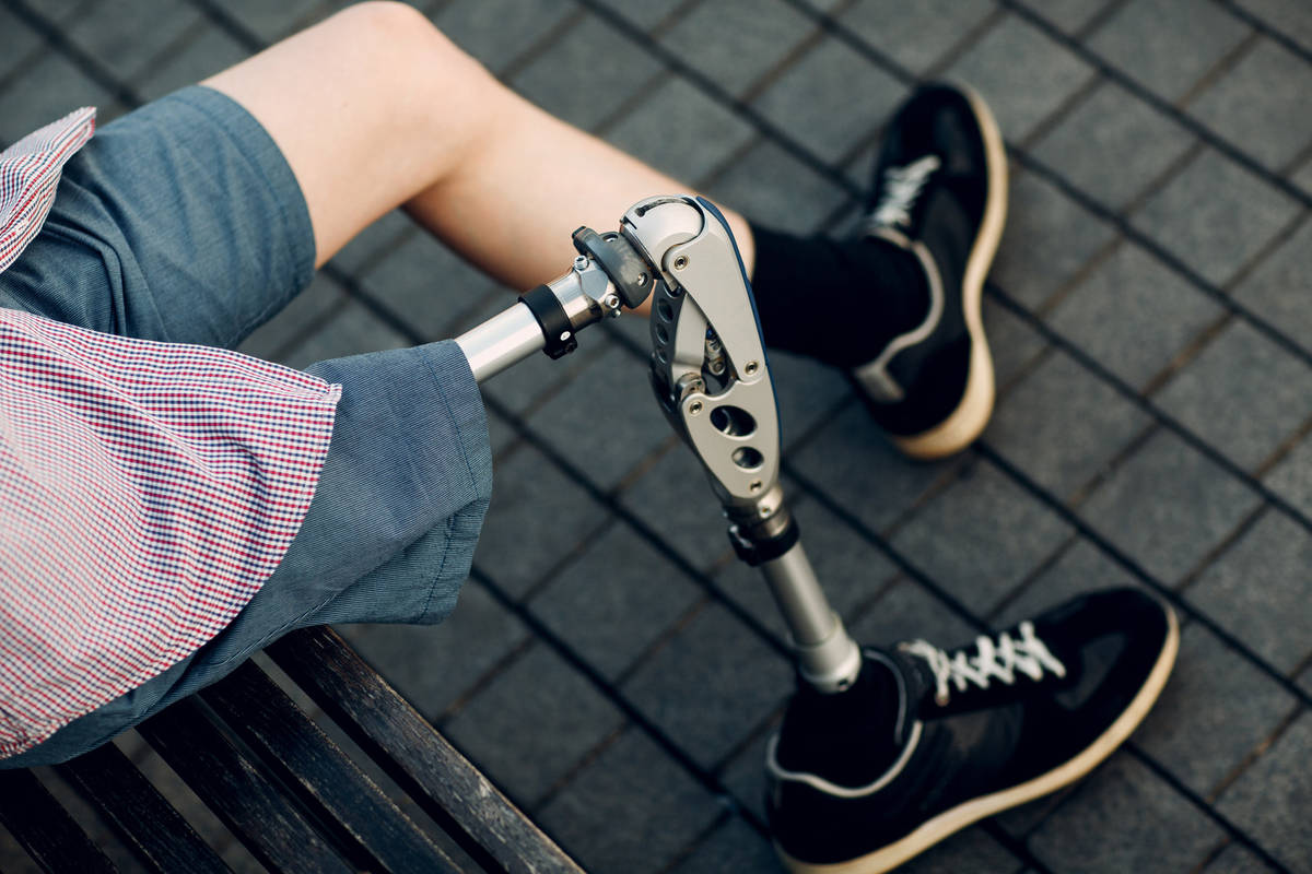 Above Knee Prosthesis