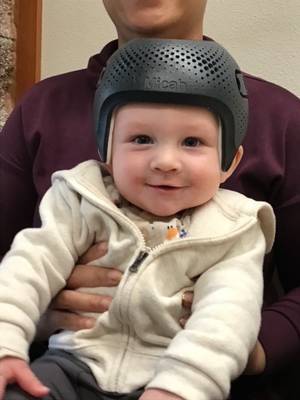 Micah has graduated from our Talee Helmet treatment. From Moderate to Normal head shape!